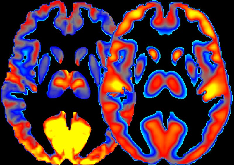 Brain metabolism and energy usage